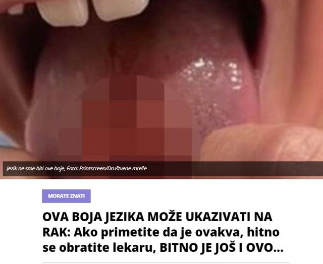 OVA BOJA JEZIKA MOŽE UKAZIVATI NA RAK: Ako primetite da je ovakva, hitno se obratite lekaru, BITNO JE JOŠ I OVO…