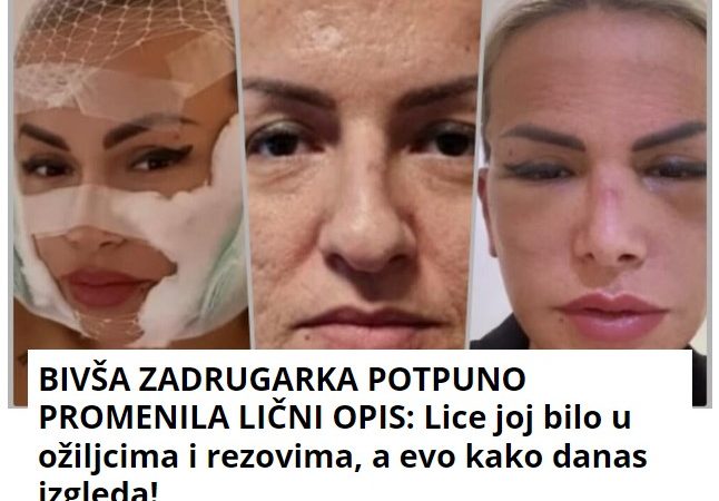 BIVŠA ZADRUGARKA POTPUNO PROMENILA LIČNI OPIS: Lice joj bilo u ožiljcima i rezovima, a evo kako danas izgleda!