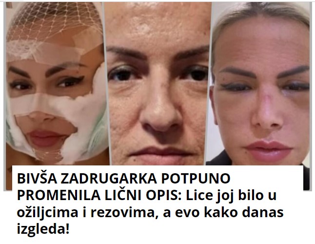 BIVŠA ZADRUGARKA POTPUNO PROMENILA LIČNI OPIS: Lice joj bilo u ožiljcima i rezovima, a evo kako danas izgleda!