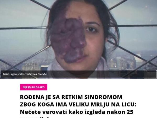 ROĐENA JE SA RETKIM SINDROMOM ZBOG KOGA IMA VELIKU MRLJU NA LICU: Nećete verovati kako izgleda nakon 25 operacija!