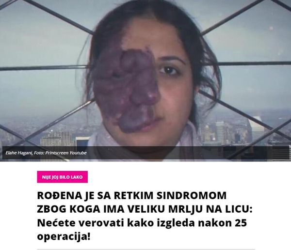 ROĐENA JE SA RETKIM SINDROMOM ZBOG KOGA IMA VELIKU MRLJU NA LICU: Nećete verovati kako izgleda nakon 25 operacija!