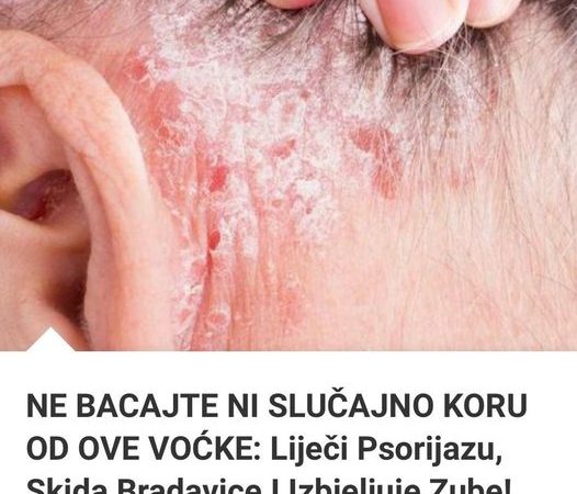 Ni Slučajno Ne Bacajte Koru Od Ove Voćke: Liječi Psorijazu, Skida Bradavice I Izbjeljuje Zube!!