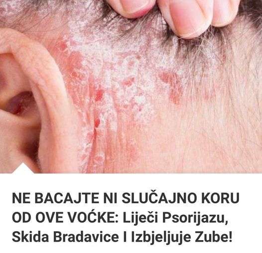 Ni Slučajno Ne Bacajte Koru Od Ove Voćke: Liječi Psorijazu, Skida Bradavice I Izbjeljuje Zube!!