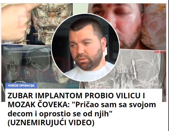 ZUBAR IMPLANTOM PROBIO VILICU I MOZAK ČOVEKA: “Pričao sam sa svojom decom i oprostio se od njih” (UZNEMIRUJUĆI VIDEO)