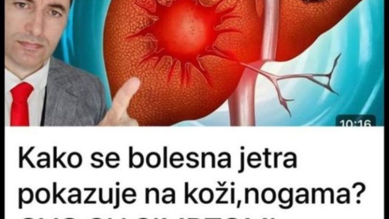 Kako se bolesna jetra pokazuje na koži,nogama? OVO SU SIMPTOMI BOLESNE JETRE…