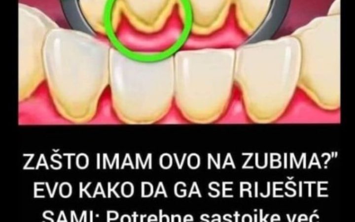 “ZAŠTO IMAM OVO NA ZUBIMA?” EVO KAKO DA GA SE RIJEŠITE SAMI: Potrebne sastojke već imate kod kuće, ZUBI ĆE BITI BIJELI KAO SA REKLAME