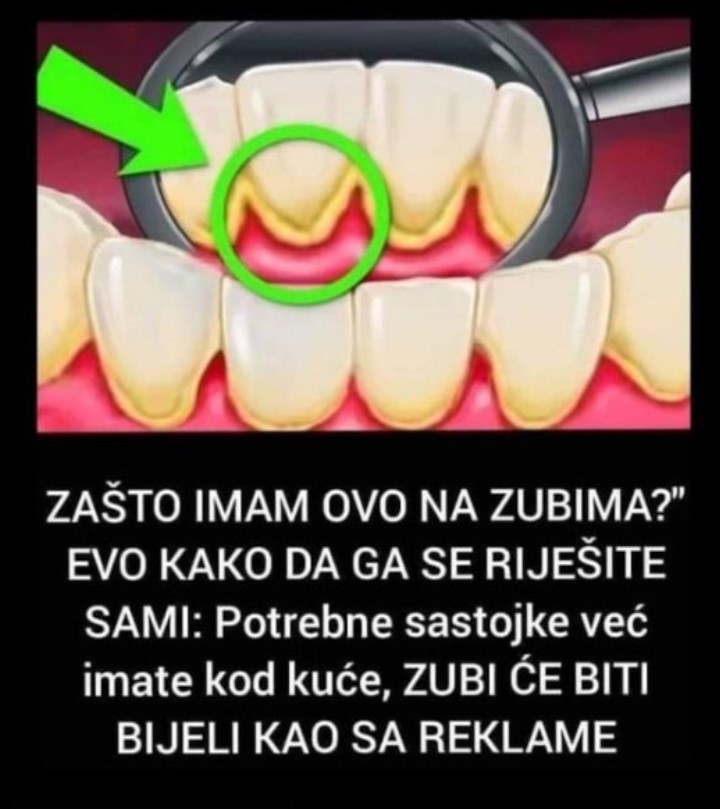 “ZAŠTO IMAM OVO NA ZUBIMA?” EVO KAKO DA GA SE RIJEŠITE SAMI: Potrebne sastojke već imate kod kuće, ZUBI ĆE BITI BIJELI KAO SA REKLAME