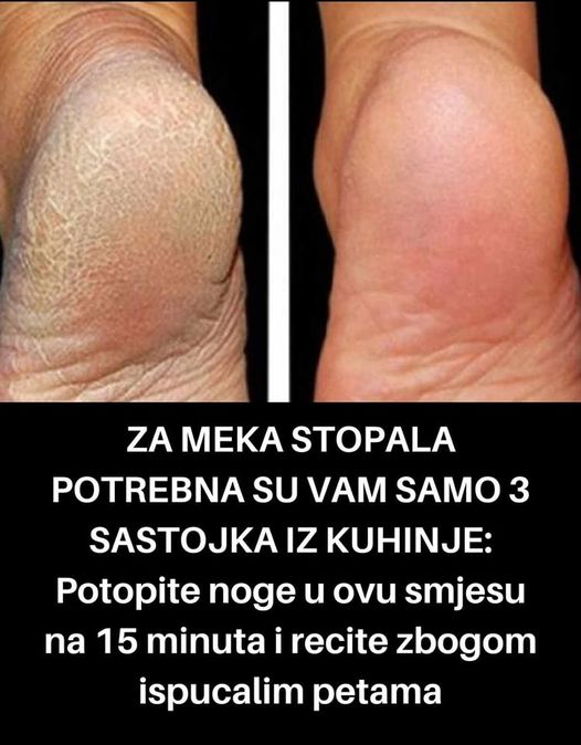 LEKOVITA MEŠAVINA ZA SAVRŠENO MEKANA STOPALA: Pedikir u KUĆNIM USLOVIMA za koji su vam potrebna samo 2 SASTOJKA!