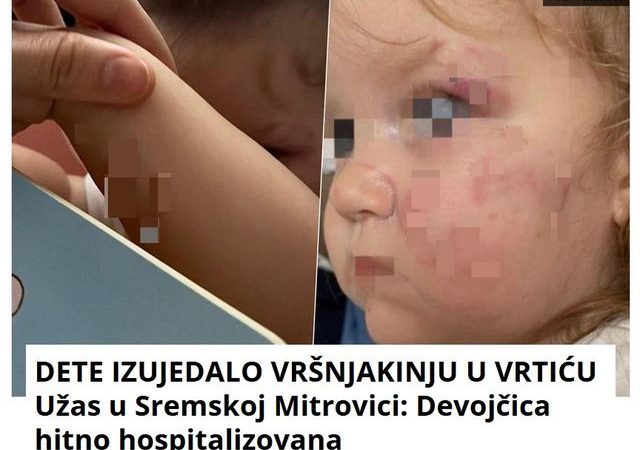 DETE IZUJEDALO VRŠNJAKINJU U VRTIĆU Užas u Sremskoj Mitrovici: Devojčica hitno hospitalizovana