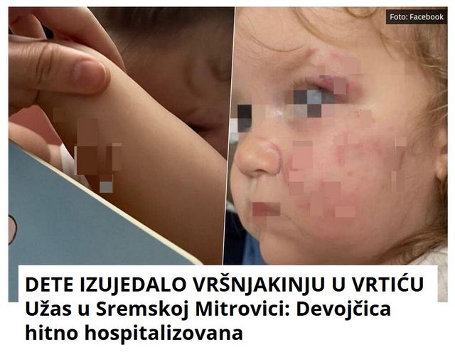 DETE IZUJEDALO VRŠNJAKINJU U VRTIĆU Užas u Sremskoj Mitrovici: Devojčica hitno hospitalizovana