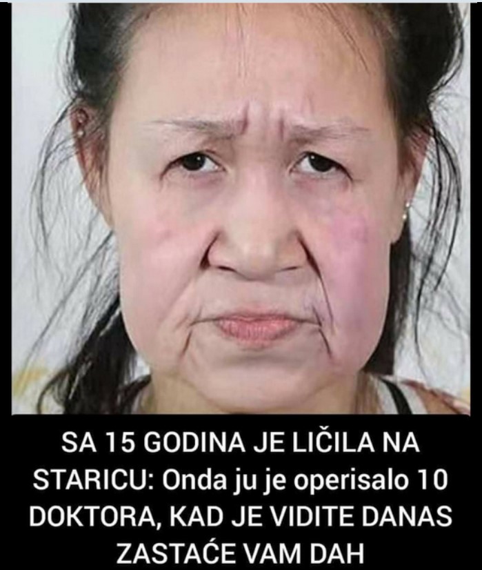 SA 15 GODINA JE LIČILA NA STARICU: Onda ju je operisalo 10 DOKTORA, KAD JE VIDITE DANAS ZASTAĆE VAM DAH! (FOTO)