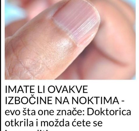 IMATE LI OVAKVE IZBOČINE NA NOKTIMA – evo šta one znače: Doktorica otkrila i možda ćete se iznenaditi