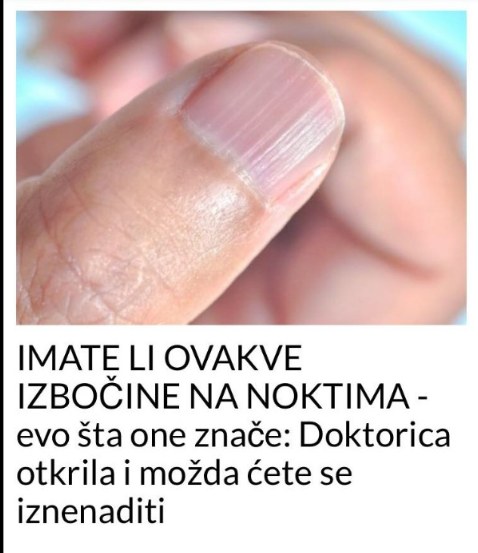 IMATE LI OVAKVE IZBOČINE NA NOKTIMA – evo šta one znače: Doktorica otkrila i možda ćete se iznenaditi